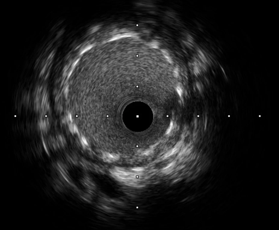 8IntraVascular UltraSound, ou échographie endovasculaire